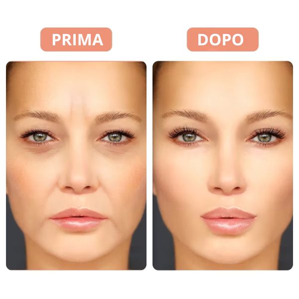 New Botox – Libera da rughe